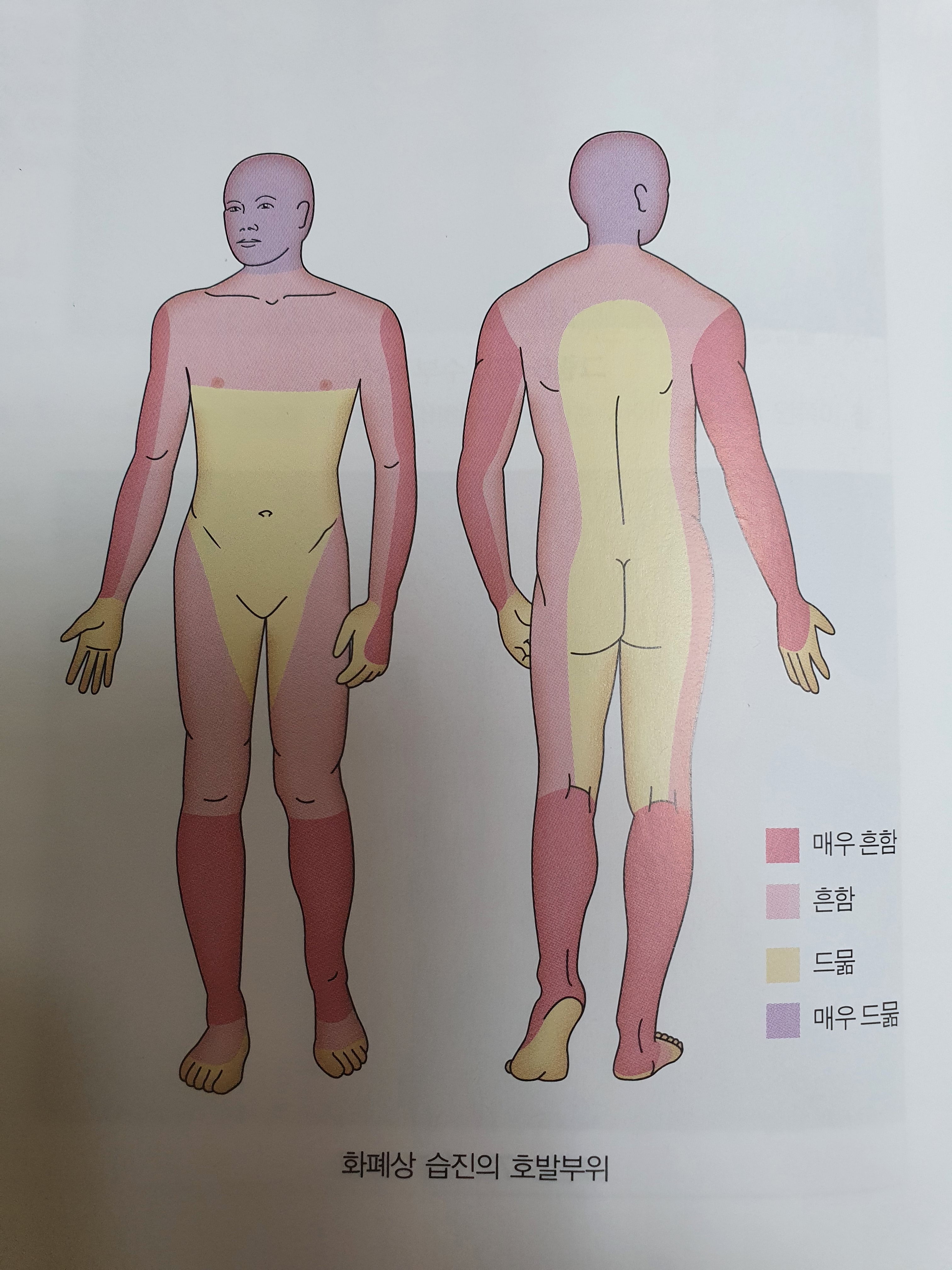 화폐상 습진