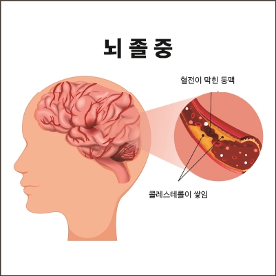 이수한의원 건강 칼럼 이미지