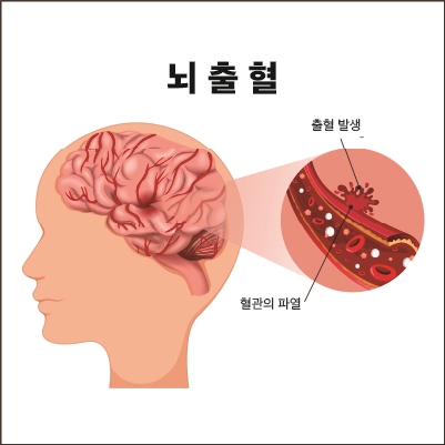 이수한의원 건강 칼럼 이미지