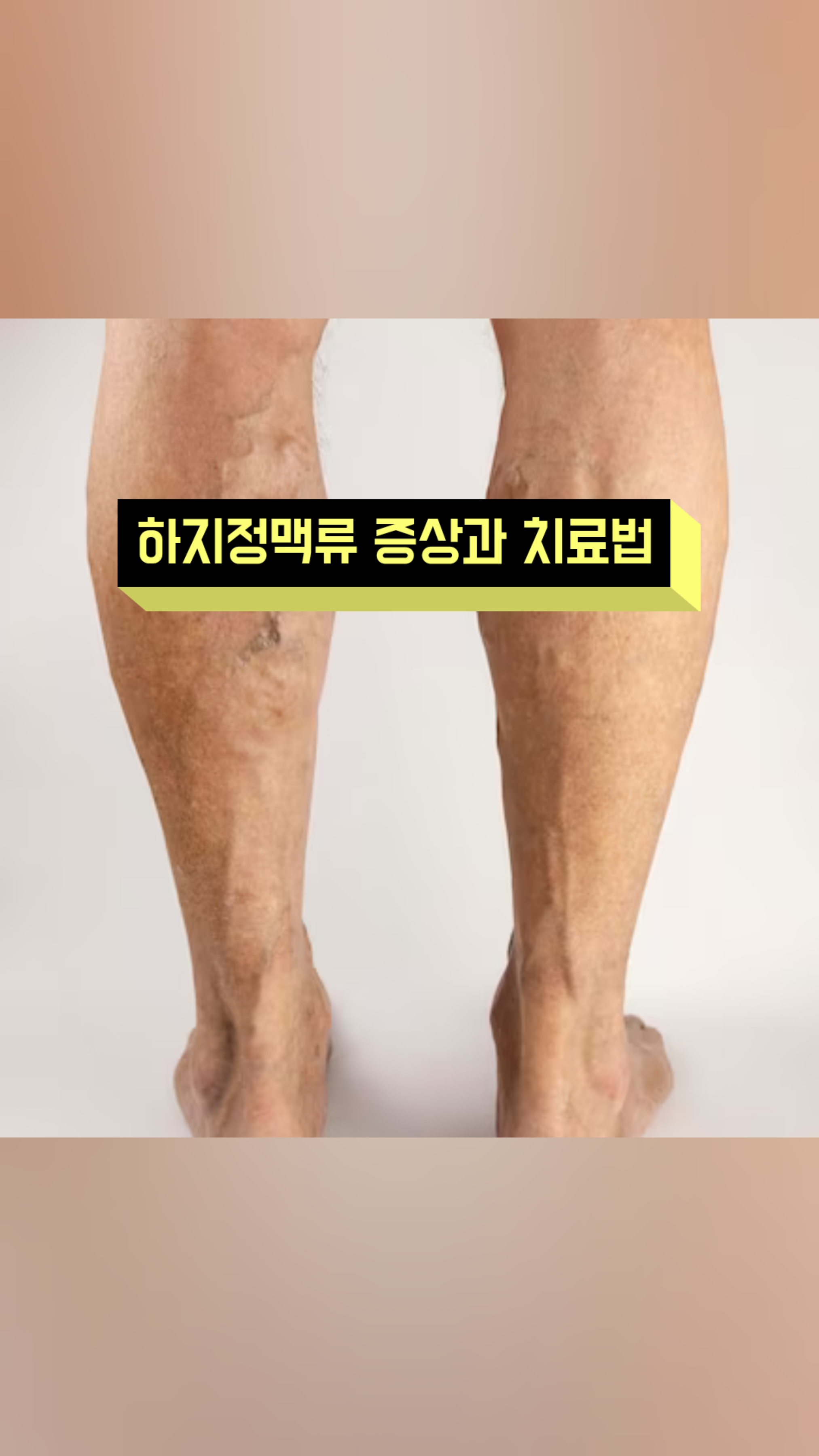 #이수한의원 #하지정맥류 #비수술적치료 #뜸과침 #계지복령환 #시령탕 #오령산 #당귀사역탕 #귀비탕