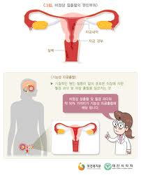 이수한의원 건강 칼럼 이미지